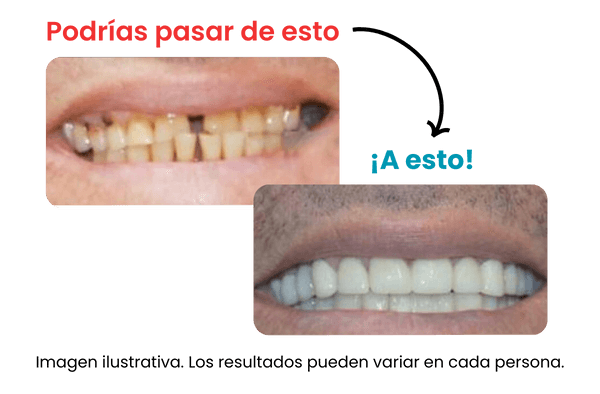 Coronas-De-Zirconia-Dentista-En-Tijuana-Zona-Rio-1